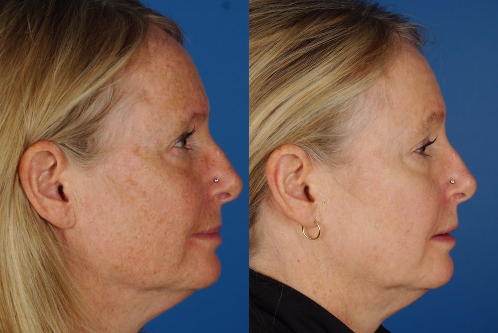 Best Laser To Remove Brown Spots On Face